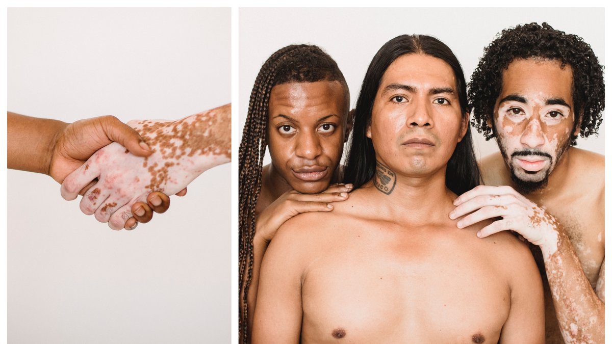 Nyheter24 reder ut allt om sjukdomen vitiligo. 